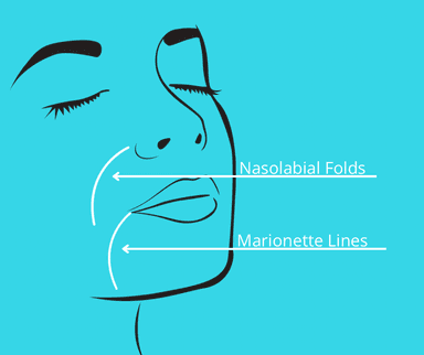 Image for Nasolabial Folds/Marionette Lines