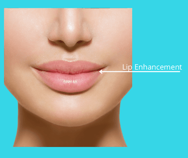 Image for Lip Enhancement/Upper or Lower Lip Lines